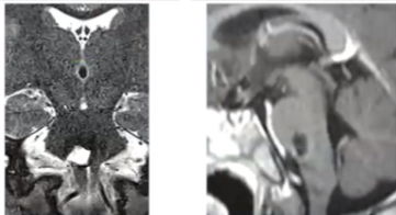 手术十分顺利，血管瘤被成功切除，且没有伤及正常神经及组织