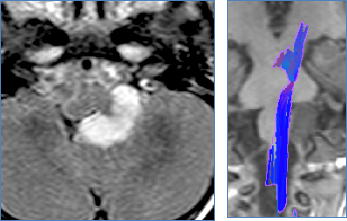 孩子确诊脑干胶质瘤,开颅对成长有影响吗?解读预后关键可控因素