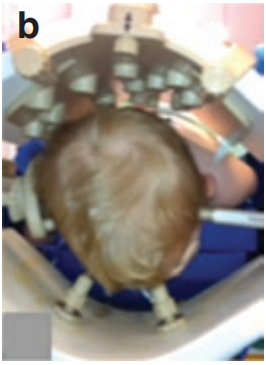 在术中磁共振系统和术中神经电生理监测的辅助下，巴教授为男孩进行了俯卧位下肿瘤切除全切手术