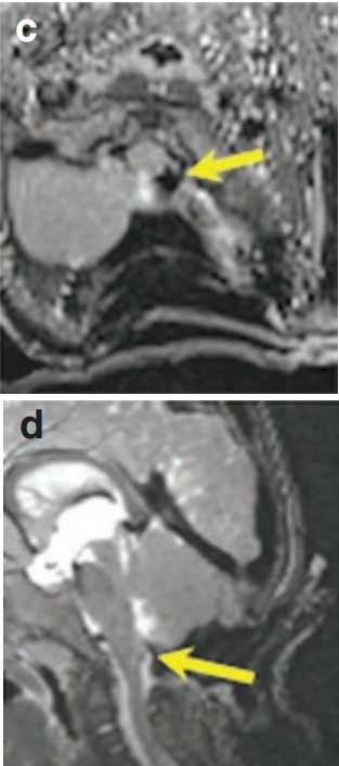 术中T1和T2MR（图c和d）显示肿瘤获得全切，无任何肿瘤残余。