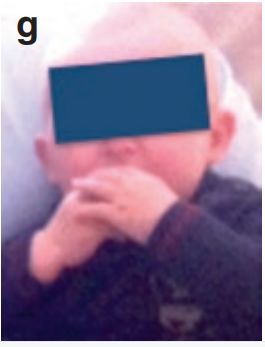 术后两周，小Nick恢复良好，依然是那个可爱的宝宝