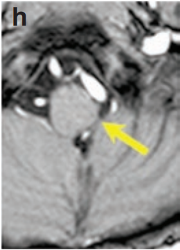 术后三年，复查的增强MRI（图h）显示，肿瘤无任何复发迹象。