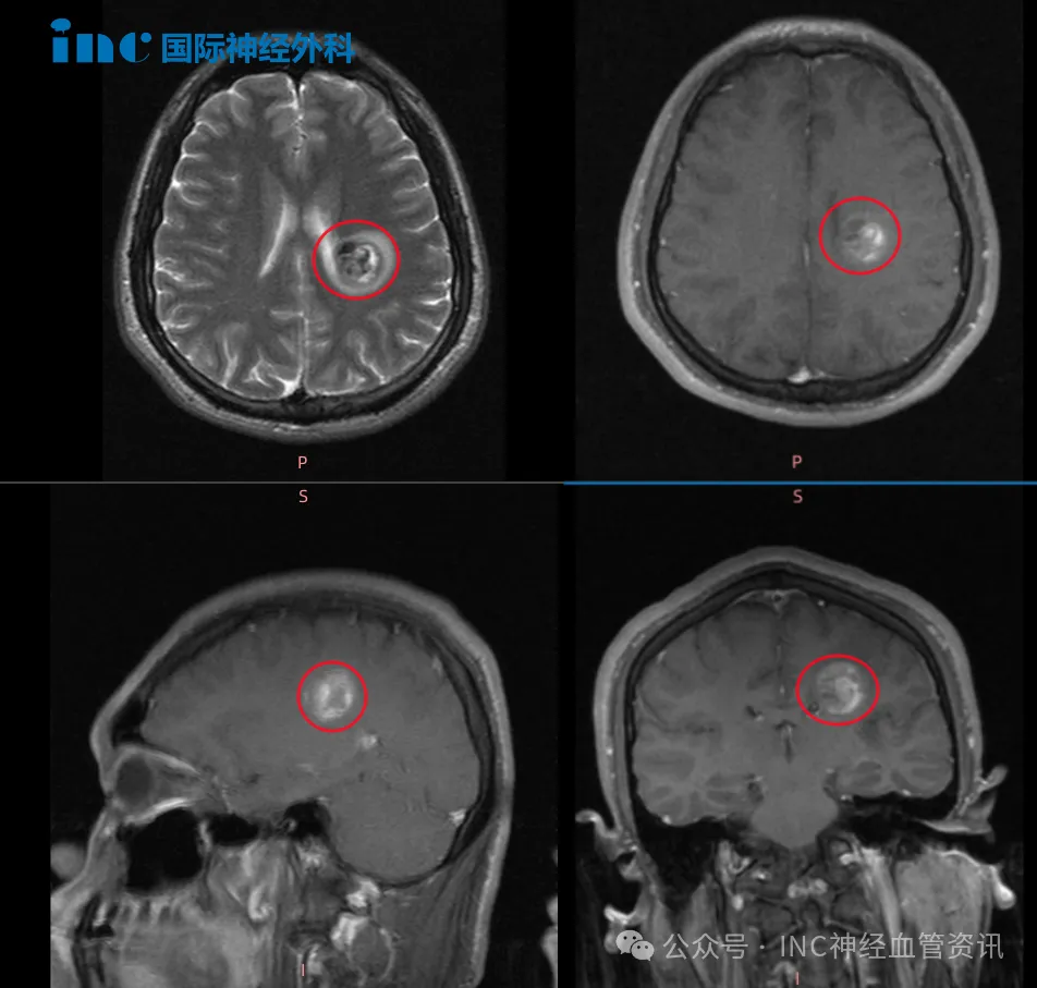 功能区海绵状血管瘤出血,导致肢体无力怎么办?