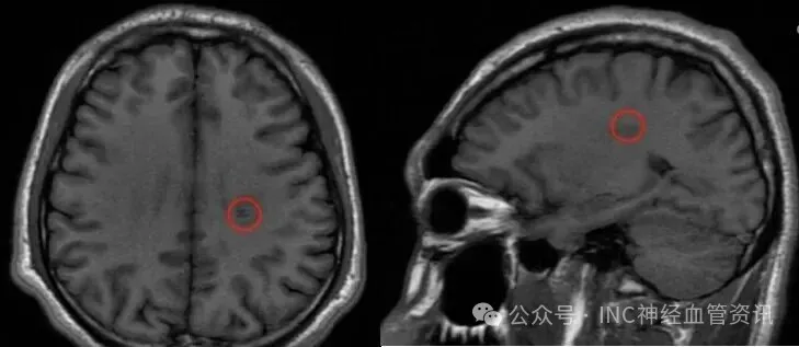 2023年3月手术前斌斌MRI影像