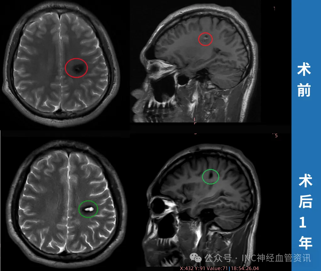 术后4天,斌斌就能自己下床走动;术后2个月,他重新骑上了自行车;术后1年随访,MRI显示病灶无残留,周围脑组织干净.