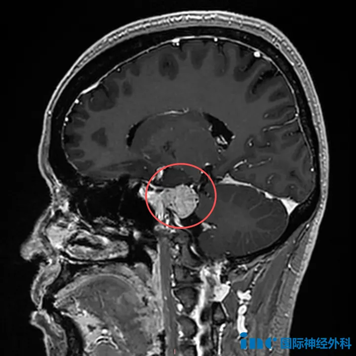为何脑膜瘤总是体检被发现？会不会长大？多项研究揭示脑膜瘤生长速度
