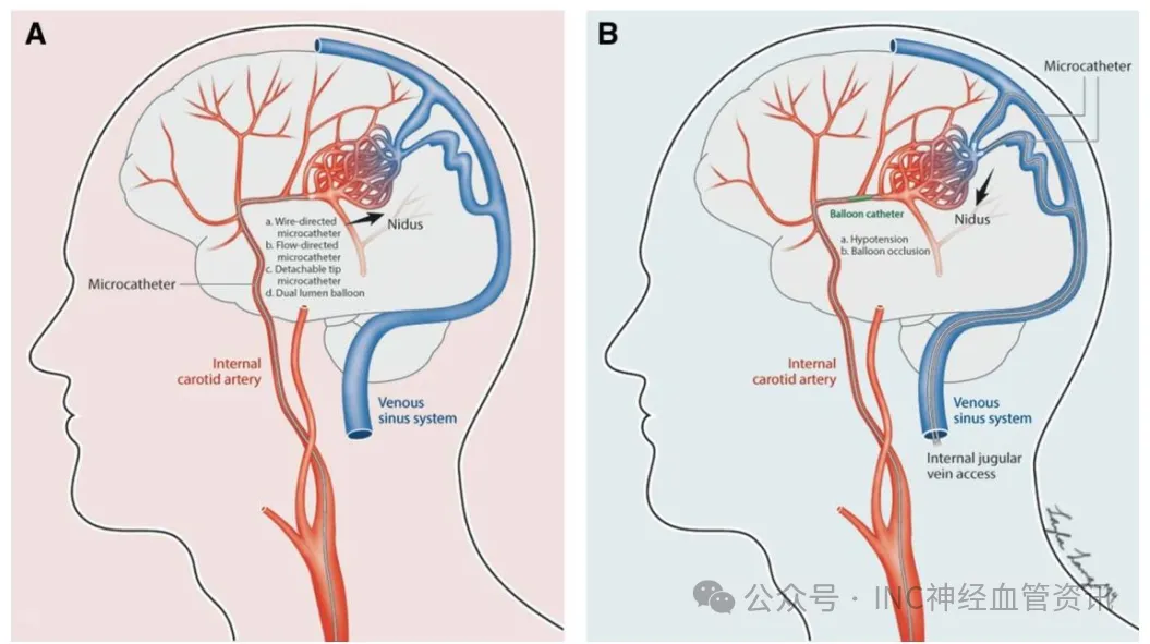 颅内动静脉畸形经动脉(A)与经静脉(B)两种治疗入路的对比示意图。