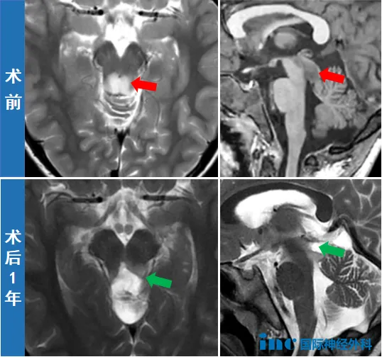 术前术后MRI对比