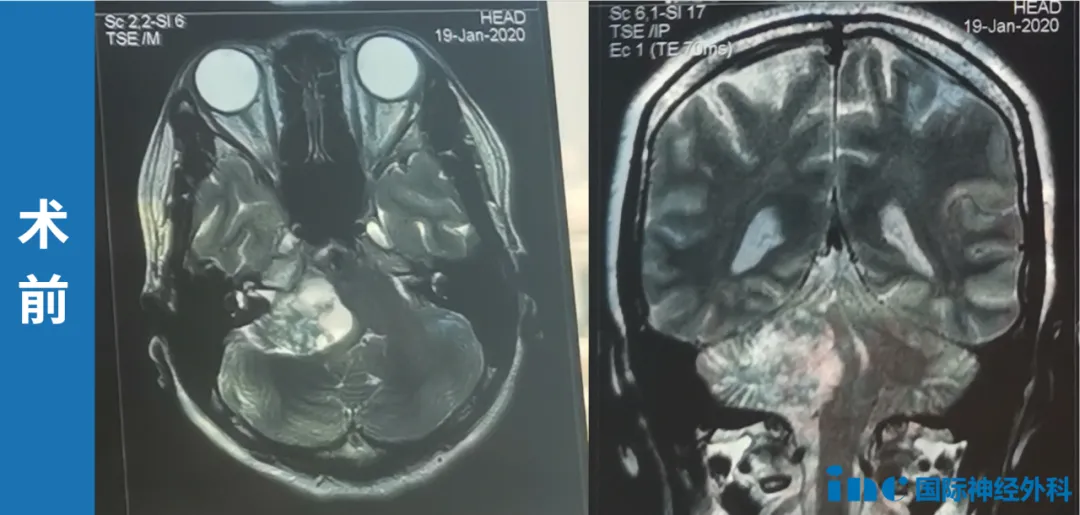 头晕、平衡变差别硬抗!可能是脑瘤生长的信号!