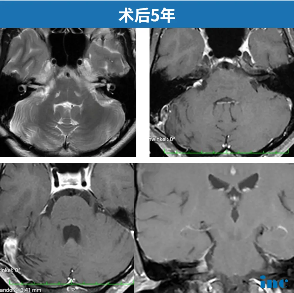 2025年11月3日,阿岚术后第五年的最新核磁共振复查结果传来捷报:影像显示“非常理想”,未见肿瘤残留或复发。