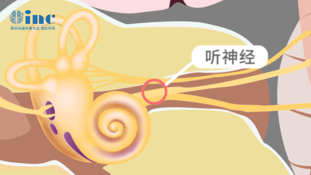 在这个狭小的三角地带内,密集穿行着面神经(掌管面部表情)、前庭蜗神经(负责听觉和平衡)、三叉神经等多组颅神经,以及小脑前下动脉等关键血管。