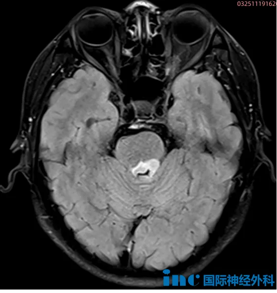 脑桥后方异常信号，约1.8cm×1.0cm，疑为脑实质肿瘤，<a href='/jiaozhiliu/' target='_blank'><u>胶质瘤</u></a>可能。