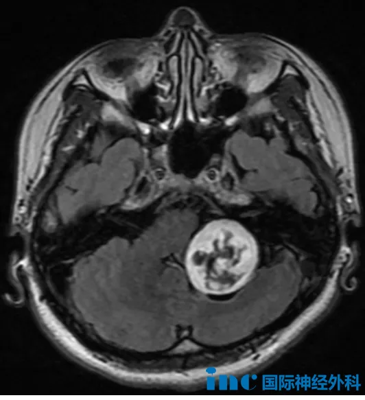 左侧桥小脑角区有一个约36×32mm的占位