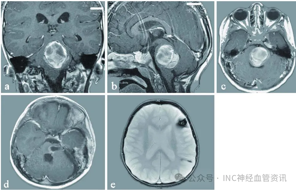 这个病会遗传?3岁女童脑干巨大海绵状血管瘤成功手术后,妈妈竟也查出同样的问题