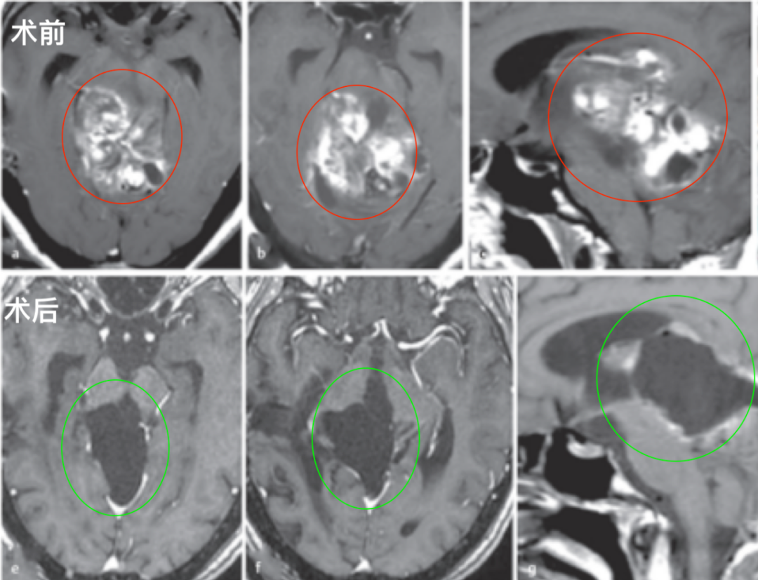 两次手术仅活检,放疗无效…良性脑干胶质瘤治疗深陷“泥潭”,她如何全身而退?