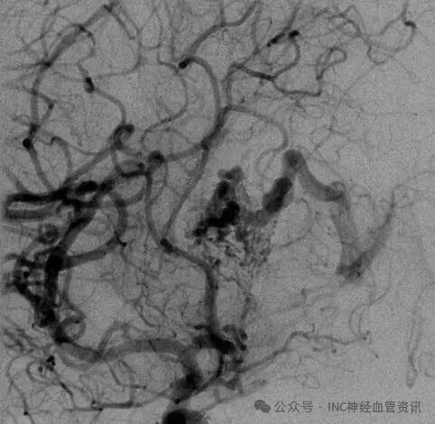 该AVM由ACA/PcaA分支、ACoA穿支和mPChA供血[右侧ICA造影