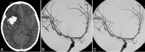 图1.A：非增强CT扫描，显示右额叶出血，侧裂内可见致密蛛网膜下腔出血。 B：右侧颈内动脉脑血管造影斜位片，显示一个5毫米大小的大脑中动脉（MCA）三分叉处动脉瘤。 C：右侧颈内动脉脑血管造影斜位片，显示MCA动脉瘤已成功实施血管内弹簧圈栓塞术