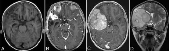 图2.A： 弹簧圈栓塞术后1.5个月获取的轴位T1加权平扫MRI图像，显示右侧额叶残余出血的演变，周围伴有额叶和颞叶脑软化。 B： 栓塞术后11个月获取的轴位T1加权钆增强MRI图像，显示右侧外侧裂内有一个2.3 × 2.7 × 1.8 厘米（前后径 × 横径 × 头尾径）的呈显著强化的软组织肿块，包绕右侧大脑中动脉三分叉并累及邻近硬脑膜。 C和D： 术后13个月获取的轴位T1加权钆增强（C）和冠状位T2加权（D）MRI图像，显示一个8 × 7.2 × 7 厘米（前后径 × 横径 × 头尾径）的呈显著强化的肿块，包绕右侧大脑中动脉，并延伸至前颅窝和中颅窝。可见明显的占位效应、中线移位及凸面硬脑膜受累。