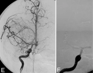 E： 右侧颈内动脉注射的右前斜位造影图像，显示大脑中动脉远端M1和M2分支变细，并可见肿瘤性毛细血管染色。F： 右侧颈内动脉注射早期动脉期获取的斜位图像，显示弹簧圈从大脑中动脉三分叉动脉瘤部位挤出。