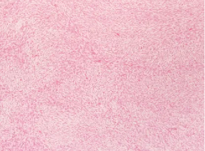 图3.上图： 病理标本染色显示高细胞密度、双相性肿瘤，上皮样细胞与梭形细胞成分呈束状排列。苏木精-伊红（H & E）染色，原始放大倍数 ×30。