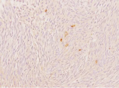 下图：S100蛋白弥漫阳性免疫组织化学染色。原始放大倍数 ×200。