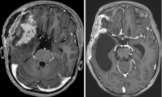 图4. 左图： 开颅术后第1天获取的轴位T1加权钆增强MR图像，显示肿瘤次全切除术后改变及周围脑软化。 右图： 开颅术后3个月获取的轴位T1加权钆增强MR图像，显示侧裂远端有残留肿瘤，并可见右侧颞角扩张。因<a href='/naojishui/' target='_blank'><u>脑积水</u></a>已行脑室腹腔分流术。