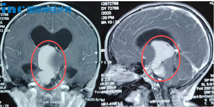肿瘤从鞍上延伸至第三脑室和桥小脑角区，并已引发脑积水。随着肿瘤向“生命禁区”脑干生长，小安的症状也日益加重。