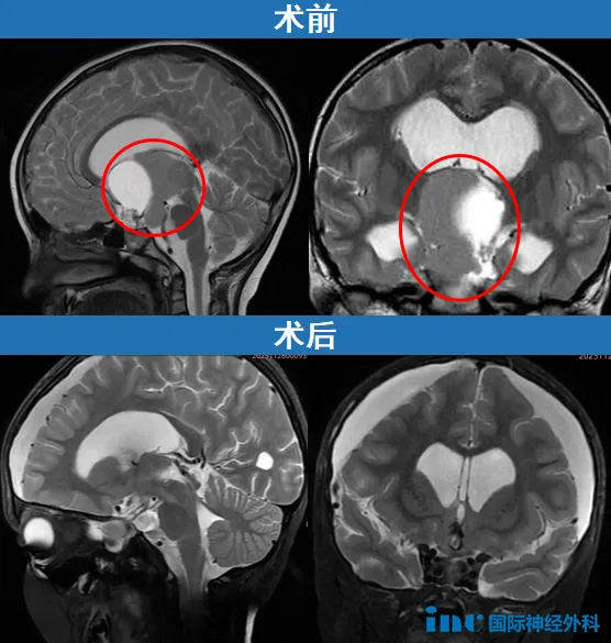 术前术后MRI对比