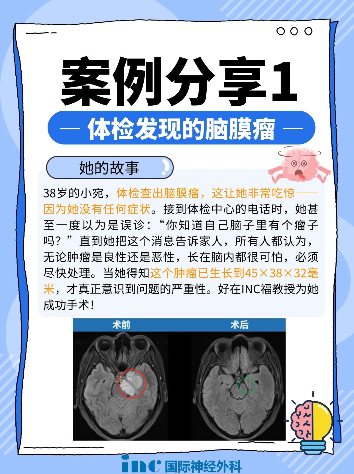 小宛的故事:天坛医院手术纪实 | 4.5cm脑膜瘤紧压脑干成功手术,勇敢辣妈的彪悍人生!