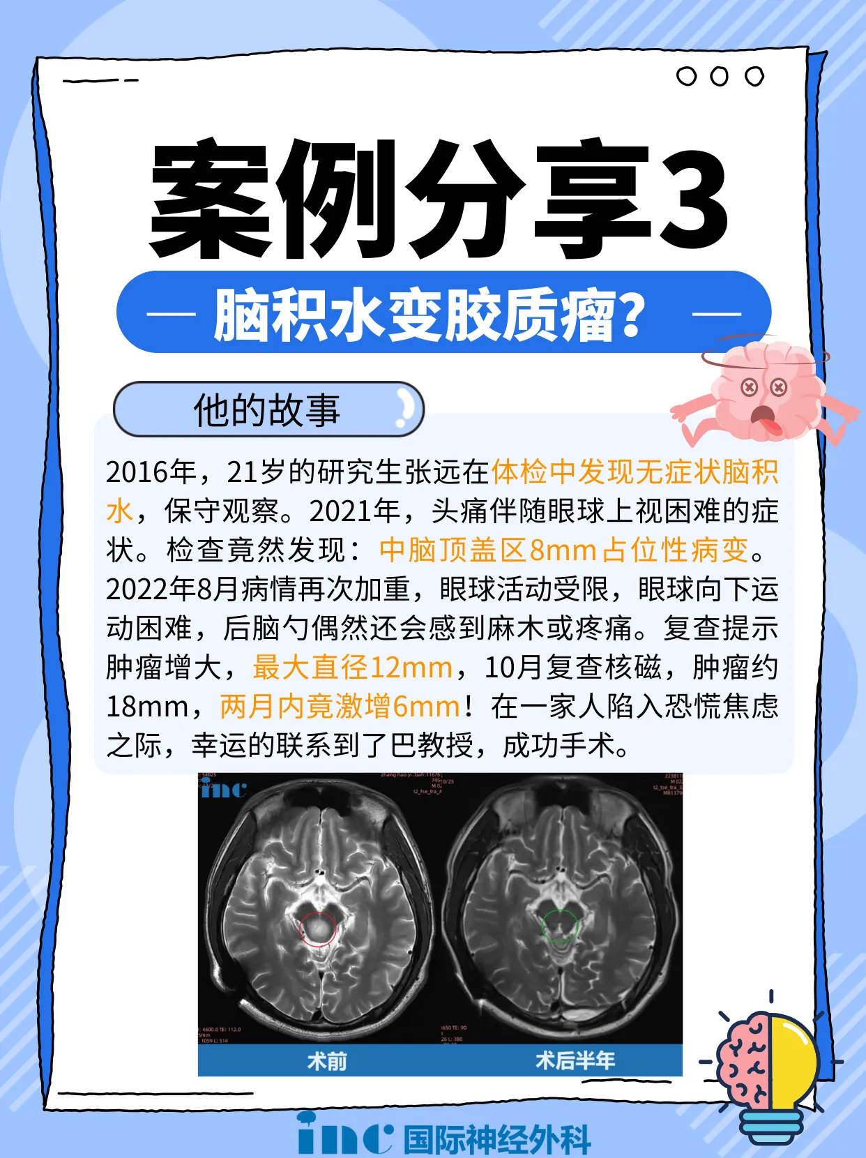 张远的故事:一台手术2个入路,一举歼灭脑干<a href='/jiaozhiliu/' target='_blank'><u>胶质瘤</u></a>:研究生学霸术后2年半怎么样了?