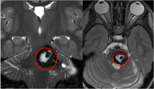 图：L同学颅脑MR显示中脑占位，混杂信号，海绵状血管瘤可能。 