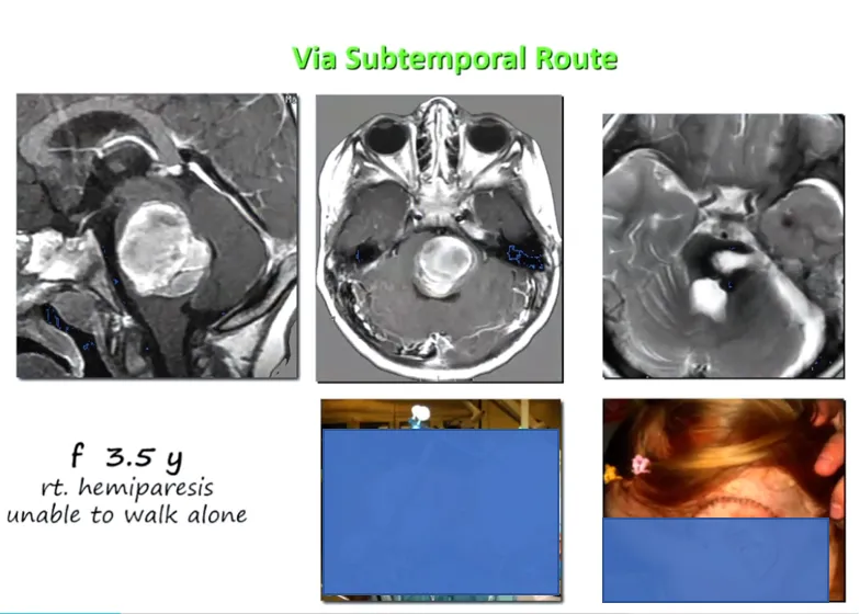 3岁半的女孩，巨大血肿，巴教授通过颞下入路进入桥脑的侧面，血肿最终清除，桥脑后方的结构是完全保留的，这是非常重要的。