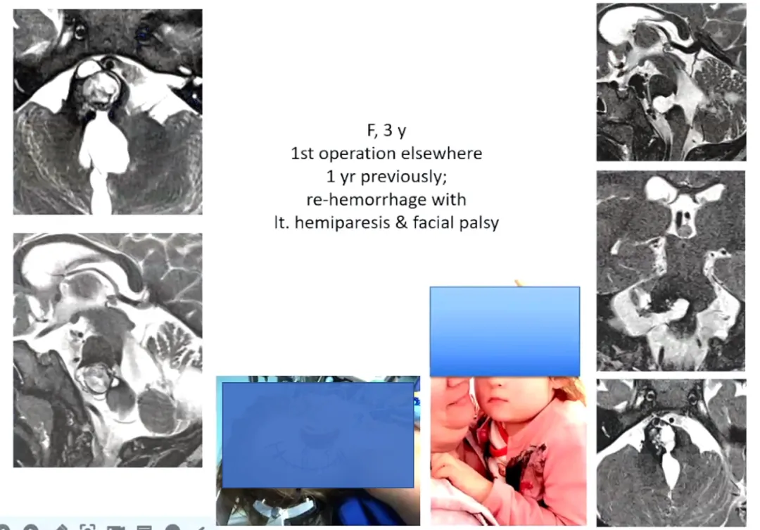 3岁孩子，已经在其他地方做过一次手术，有一部分病灶没有切除。出现外展神经麻痹和面瘫。最终巴教授为其全切，孩子预后良好。