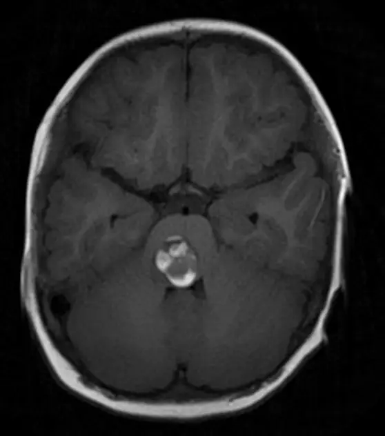 “能救孩子，我们在所不惜！”2岁女儿脑干出血，全切术后症状消失！