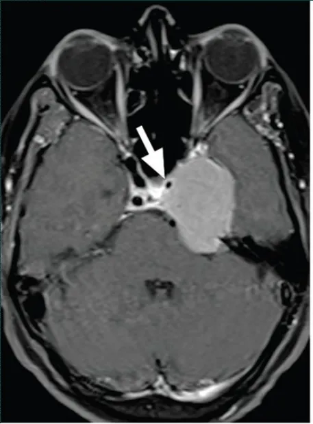 海绵窦脑膜瘤合并左侧颈内动脉狭窄，手术难度大