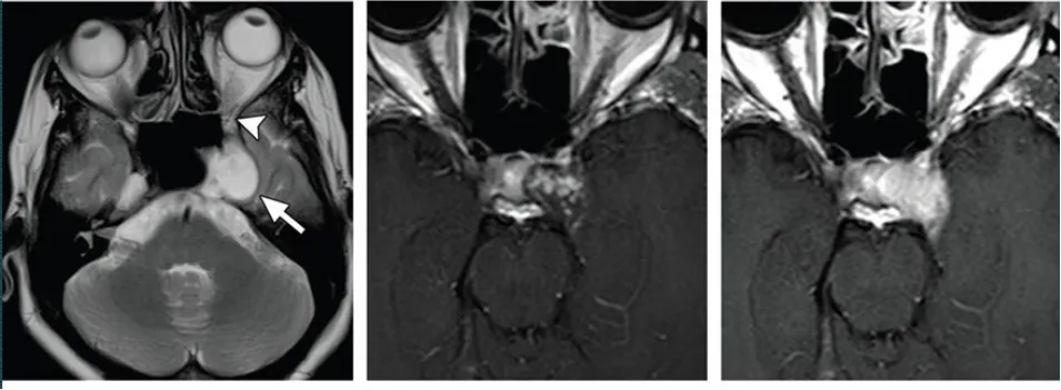 海绵窦血管瘤，T2高信号，累及左侧Meckel腔