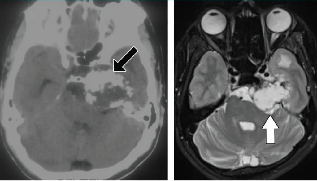 软骨肉瘤，岩尖膨胀性骨质 破坏，累及左侧海绵窦后部
