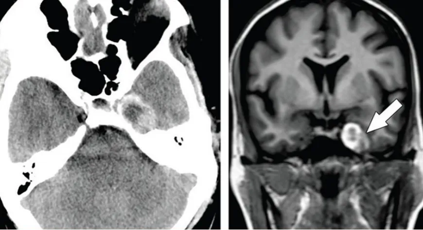 海绵窦黑色素瘤，和海绵状血管瘤容易混淆