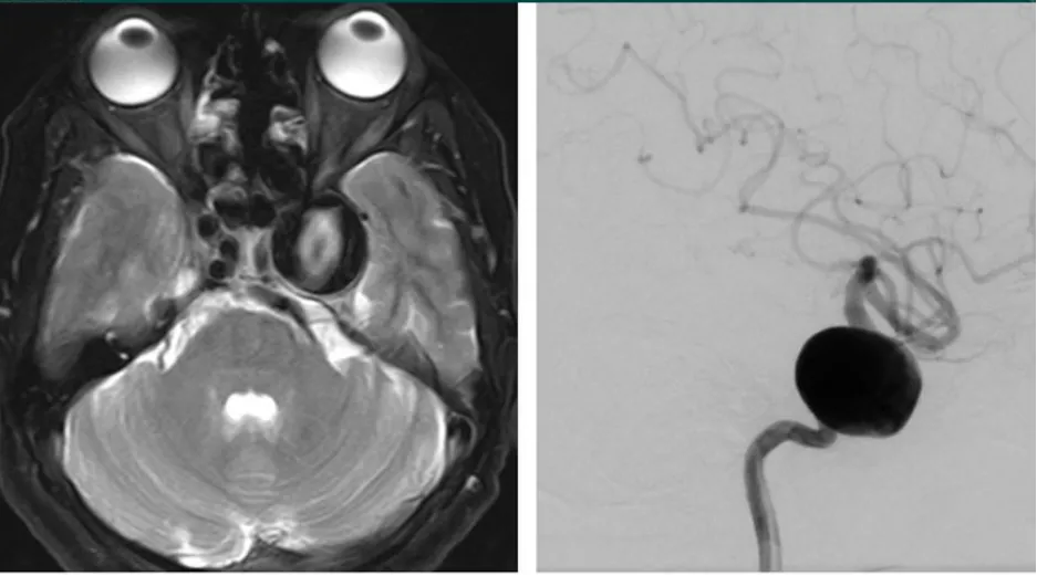 海绵窦区颈内动脉瘤
