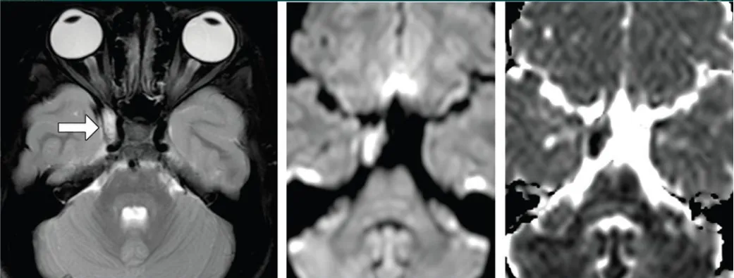 海绵窦区表皮样囊肿