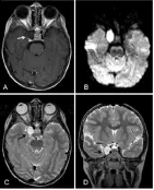 病灶在t1加权像上呈低信号，周围有高信号，在t2加权像上呈高信号且不均匀。增强检查除了病灶边边缘轻微强化，未见增强。病变压迫海绵窦内颈动脉(ICA)。