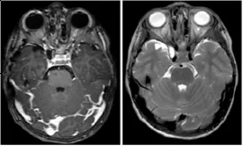 海绵窦神经血管结构减压，无肿瘤残留或复发；术后FLAIR图像中术前高信号完全消失。
