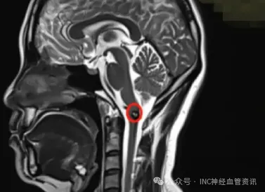 第二天的脑部MRI检查，给了她沉重一击：急性血管团，确诊延髓海绵状血管瘤。