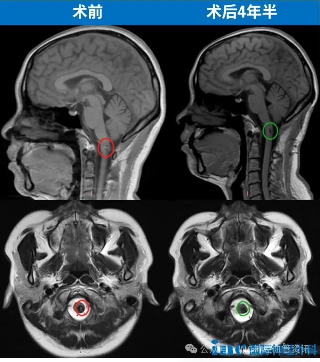 手术很顺利。王女士只在ICU待了一天，第二天就转回了普通病房。术后第五天，王女士已经可以下床活动。