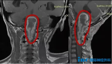 “我想活下去！”3天后，脑干胶质瘤女孩的生日愿望实现了