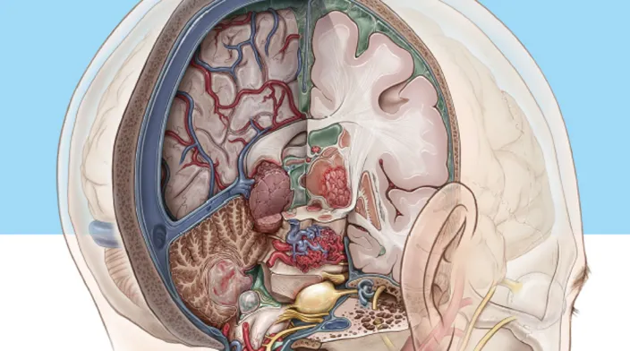 桥小脑角区（CPA）占位手术风险有哪些？