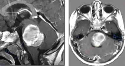 脑干海绵状血管瘤破裂出血