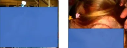 巴教授谨慎地通过颞下入路进入桥脑的侧面，血肿最终成功清除，而桥脑后方的结构也完全保留，这对于小女孩将来的生活质量非常重要，意味着术后的她不会产生任何额外的功能损伤。