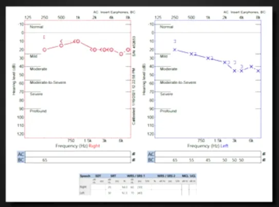 （术前听力图）
