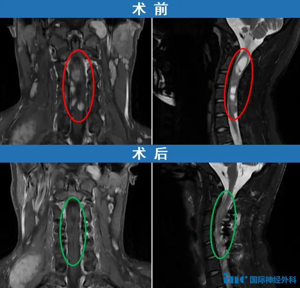 术前术后MRI对比